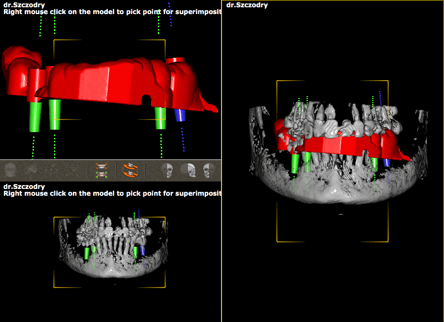 Planowanie pozycji implant